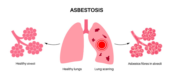 Azbestóza, onemocnění plic způsobené vdechováním azbestových vláken, která se ukládají v plicích (napravo).