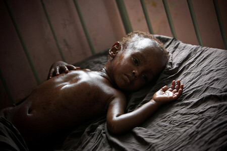 V roce 2000 se země světa dohodly na snížení počtu lidí trpících hladem o polovinu. Ve skutečnosti jich ale přibývá. Na snímku podvyživené a dehydratované dítě v nemocnici v somálském Mogadišu